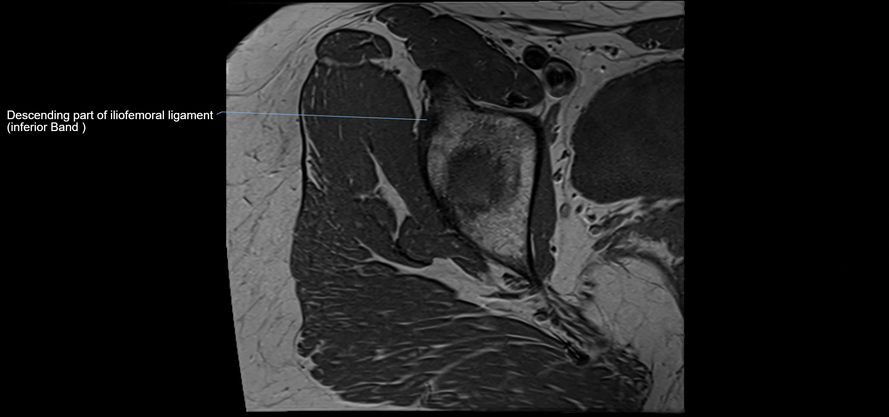 Hip ligament anatomy axial 3T MRI image -img-13001-00009.webp